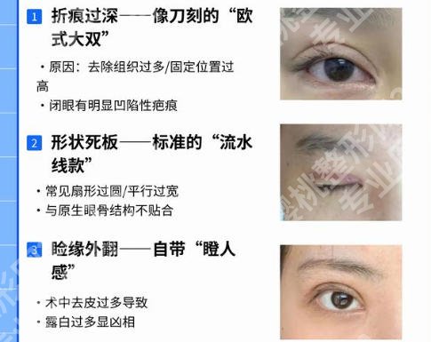 蚌埠医学院附属医院做双眼皮怎么样?双眼皮案例分享及基本信息分享!