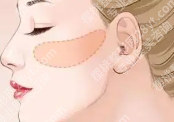 上海东方医院磨骨手术费用|下颌30673—67058元左右!
