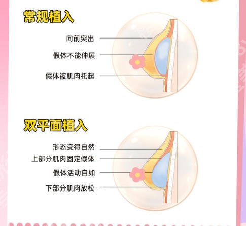 上海第一人民医院假体隆胸多少钱?2026真实费用与避坑指南速看