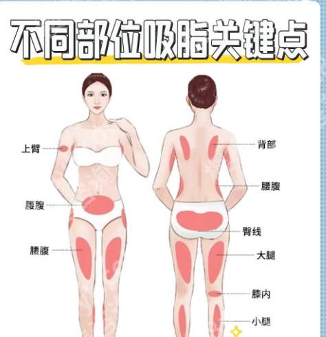 深圳人民医院抽脂是怎么收费?单部位23,000~33,000元左右!