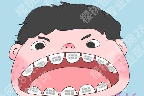 中山人民医院牙齿矫正怎么样？传统矫正、半隐形矫正、隐适美等收费区别分享