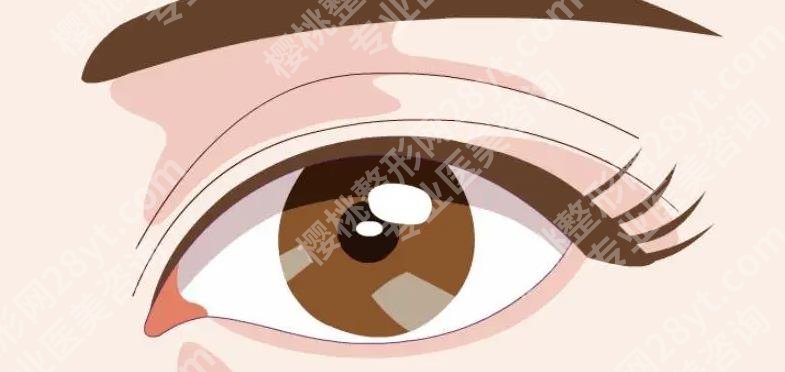 上海新华医院割双眼皮怎么样?埋线、全切、三点等那种更自然?
