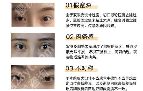 上海中山医院双眼皮张汝凡怎么样？真实经历看这、全是干货