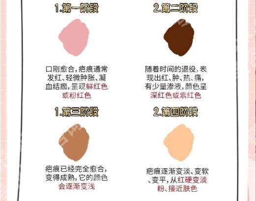 浙大二院疤痕好吗？附挂号指南与真实案例