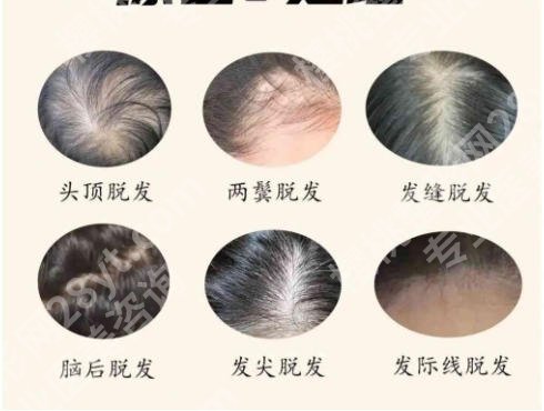 深圳植发医院哪家医技术好?2026口碑榜单揭晓!