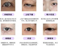 邯郸三院做双眼皮案例图展示！术后效果自然！附2026收费公布！