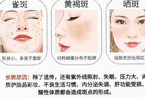 深圳北大医院激光祛斑效果怎么样？真人案例和术后注意事项盘点