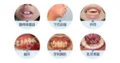 北医三院牙齿正畸费用表更新！