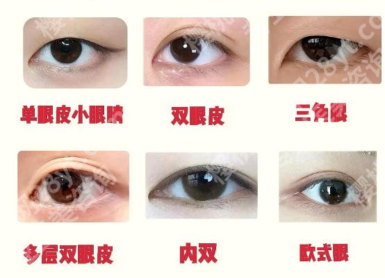 上海华山医院割双眼皮丁志技术如何?2026真实案例展示!