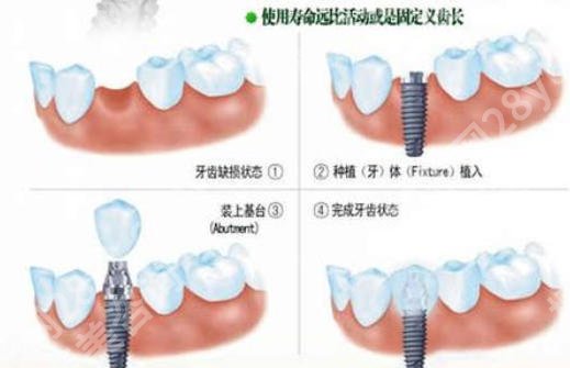 南方医科大学第五附属医院牙科贵吗?2026种植牙收费细节展示!戳进来看