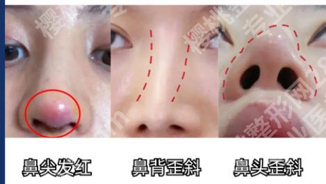 上海八院隆鼻怎么样？看专家案例和简介就知道！
