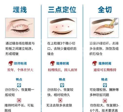 北京医院双眼皮手术多少钱一次?不同手术方式价格对照!