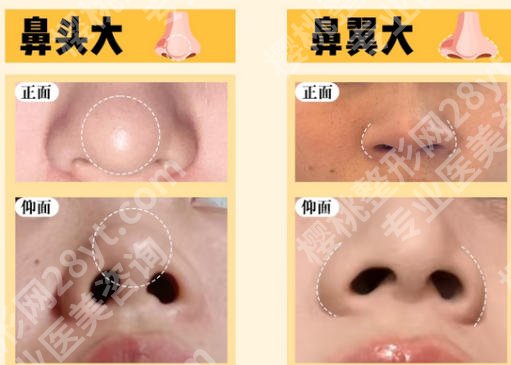 北京协和医院鼻子谁做得好？黄渭清、王晓军等技术在线！