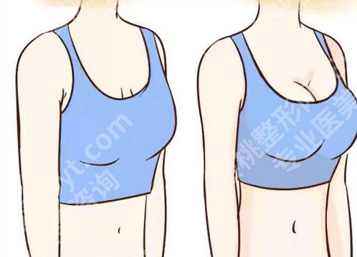 上海仁济医院隆胸价格贵不贵？假体隆胸2万左右起！