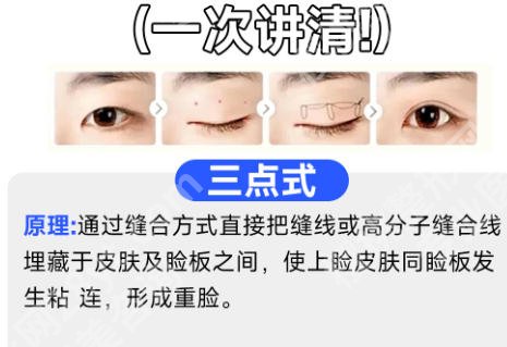 珠海人民医院割双眼皮价格揭晓!网友真实评价一览!