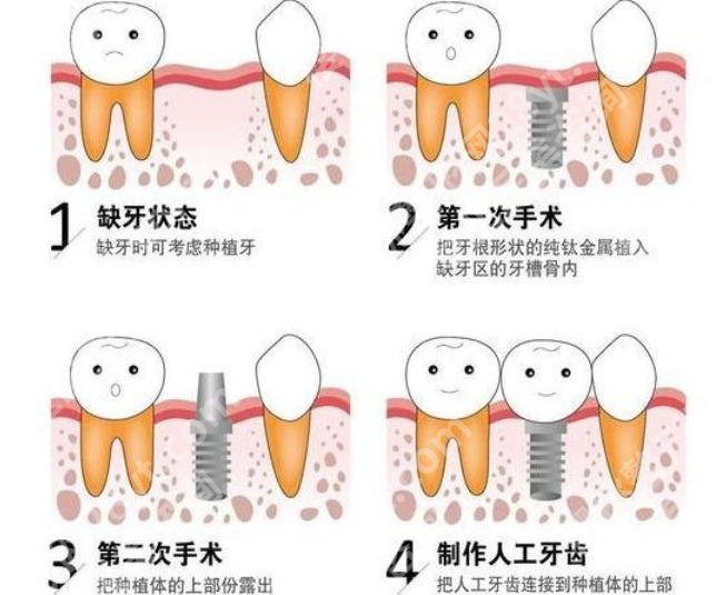 上海第八人民医院种植牙价格贵不贵?2026收费细节展示!
