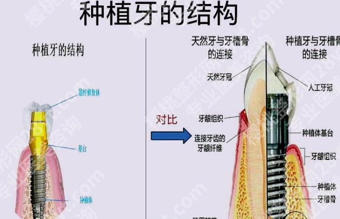 中大五院种植牙价格贵不贵？2026经典案例展示！戳进来看