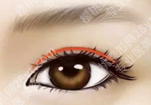 杭州双眼皮修复刘中策怎么样?面诊/预约/案例分享全过程