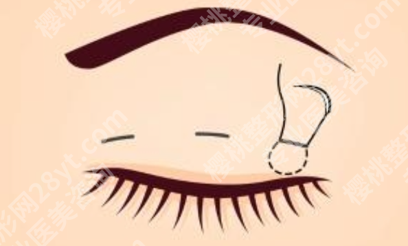 承德做双眼皮好的美容医院有哪些?2026年机构信息整理,眼整形特色一览