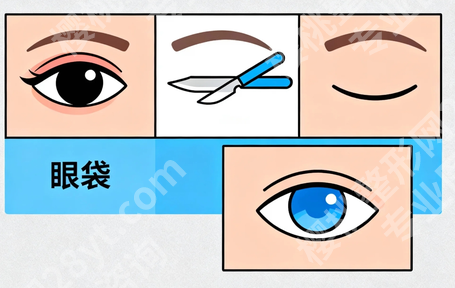 马鞍山去眼袋厉害的三个医院都有谁？当地眼部整形资源了解一下