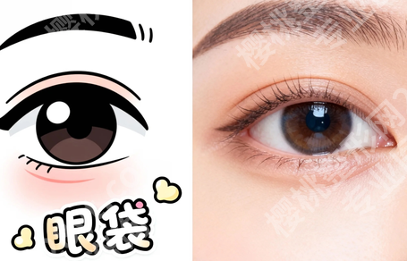 柳州哪里有做眼袋手术的｜不用到处打听了，本地这些医院可以了解一下