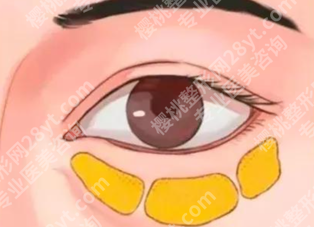 安阳去眼袋修复手术哪个医院好？二次修复与初次手术有何不同，重点解析