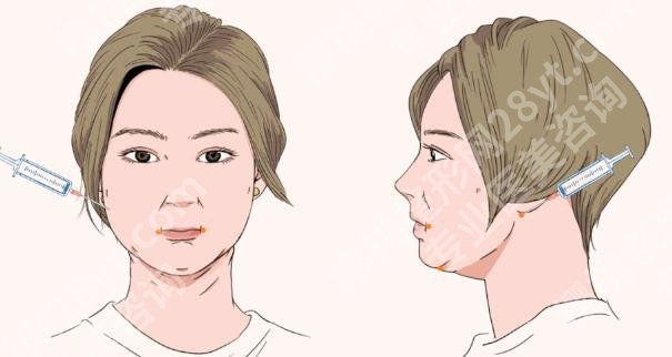 九院面部吸脂多少钱?腰部、面部等部位均价1w-3w左右!