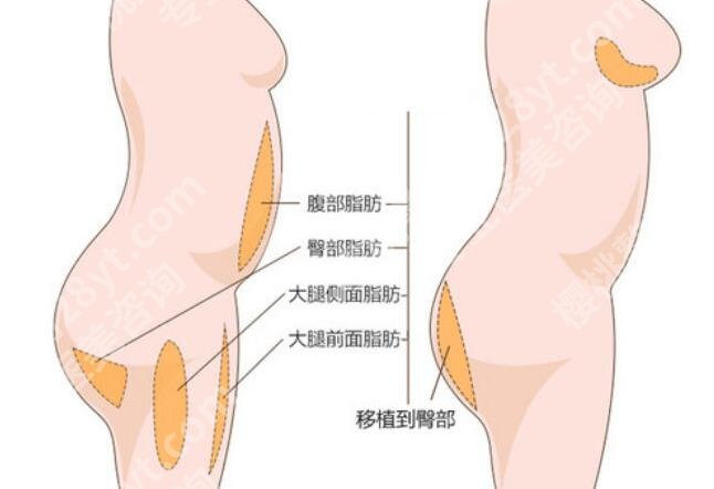 上海九院抽脂臀线修复技术咋样？人气医生名单揭晓！