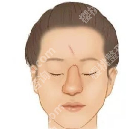 上海九院做鼻骨复位多少钱?大概12,000~38,000左右|真实评价来袭