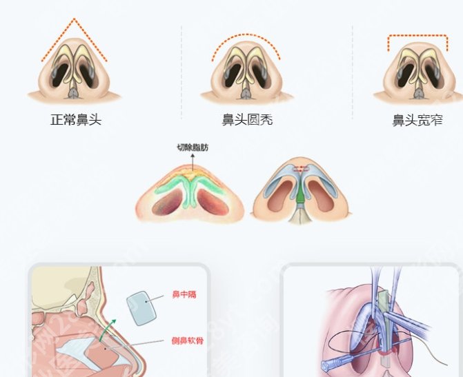 上海九院做鼻骨复位多少钱?大概12,000~38,000左右|真实评价来袭